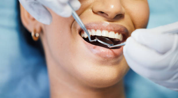 Best Emergency Wisdom Teeth Removal in Mendota, IL