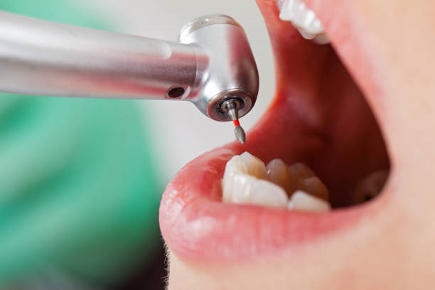 Best Emergency Tooth Extraction in Mendota, IL